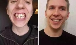 娱乐圈爆料卡通牙套,卡通牙套引领娱乐圈新潮流